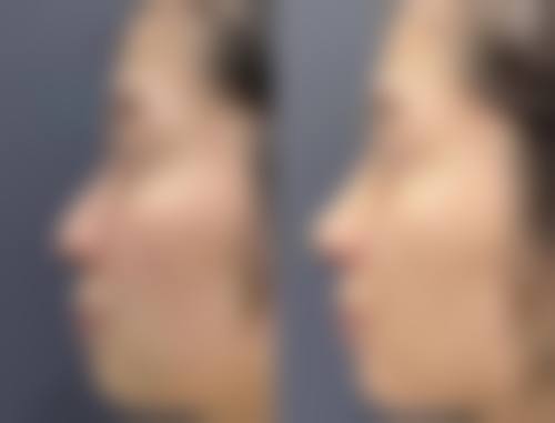 三、疤痕体质潜在并发症风险的坏处