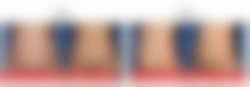 一、颧骨突出成因分析