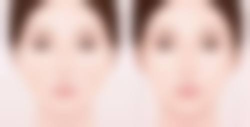 双眼皮吊顶吊多少公分合适？