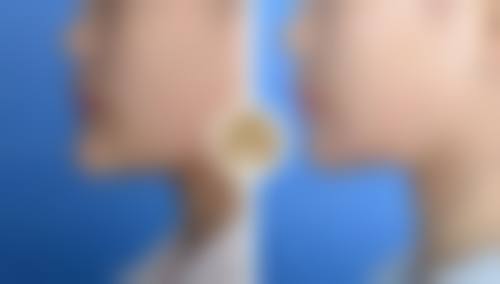 一、不同生活阶段下什么时候隆胸比较好