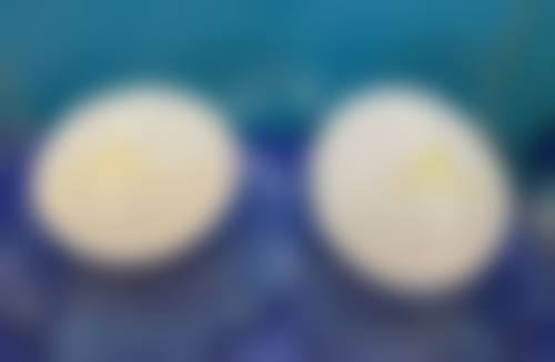 四、双眼皮埋线消肿异常情况及应对措施