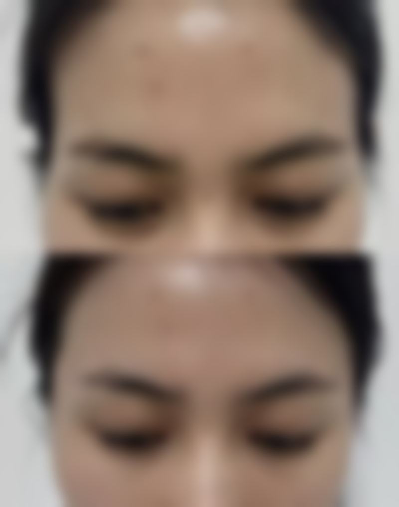 一、无花果去眼袋的原理及说法来源