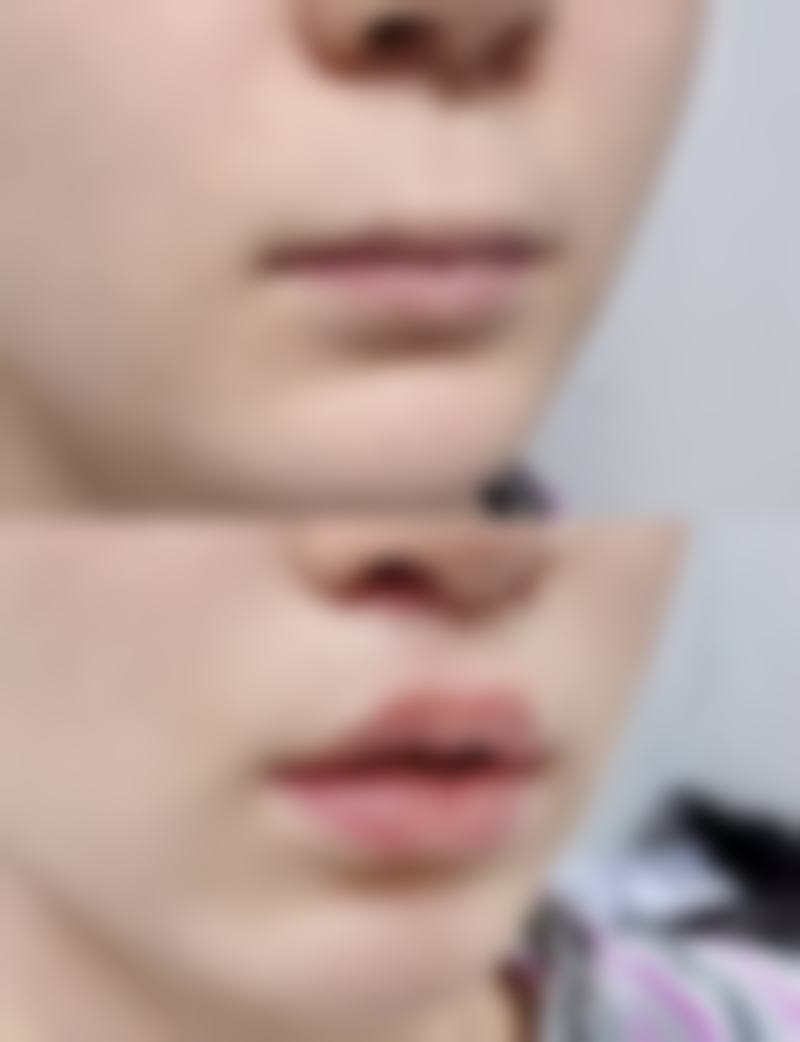 五、其他辅助去眼袋的方法