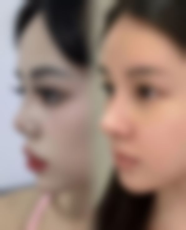 四、双眼皮拆线后的护理