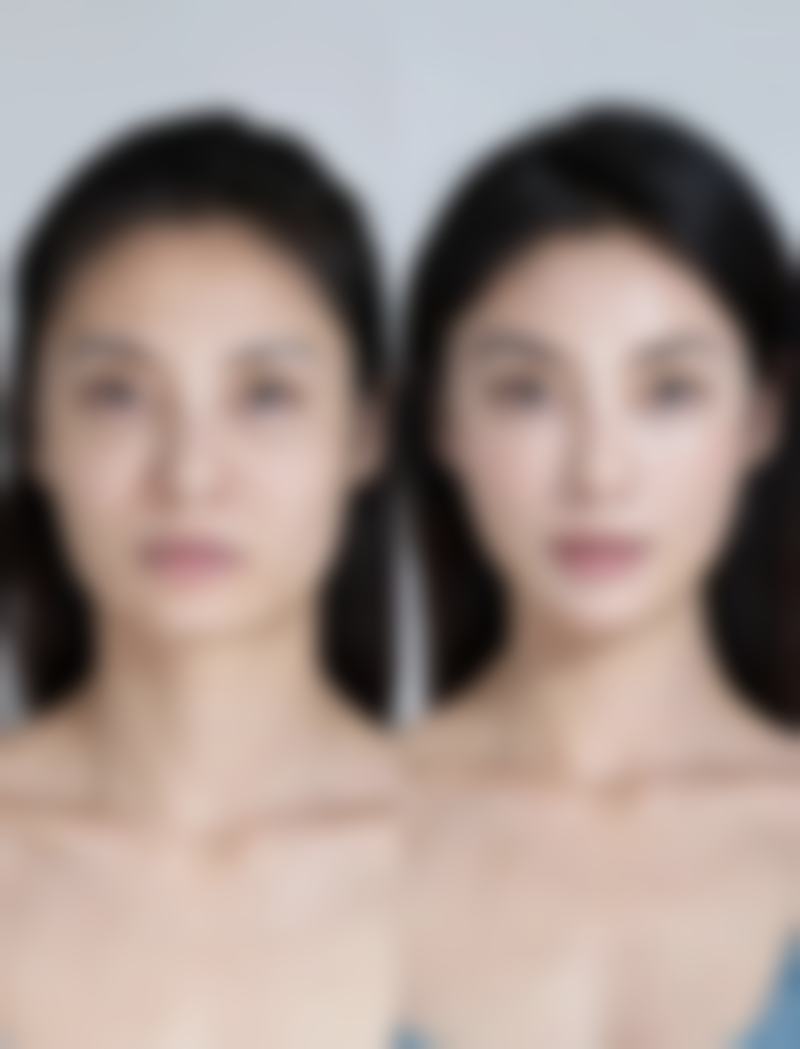 一、双眼皮埋线的基本原理和常规维持时间