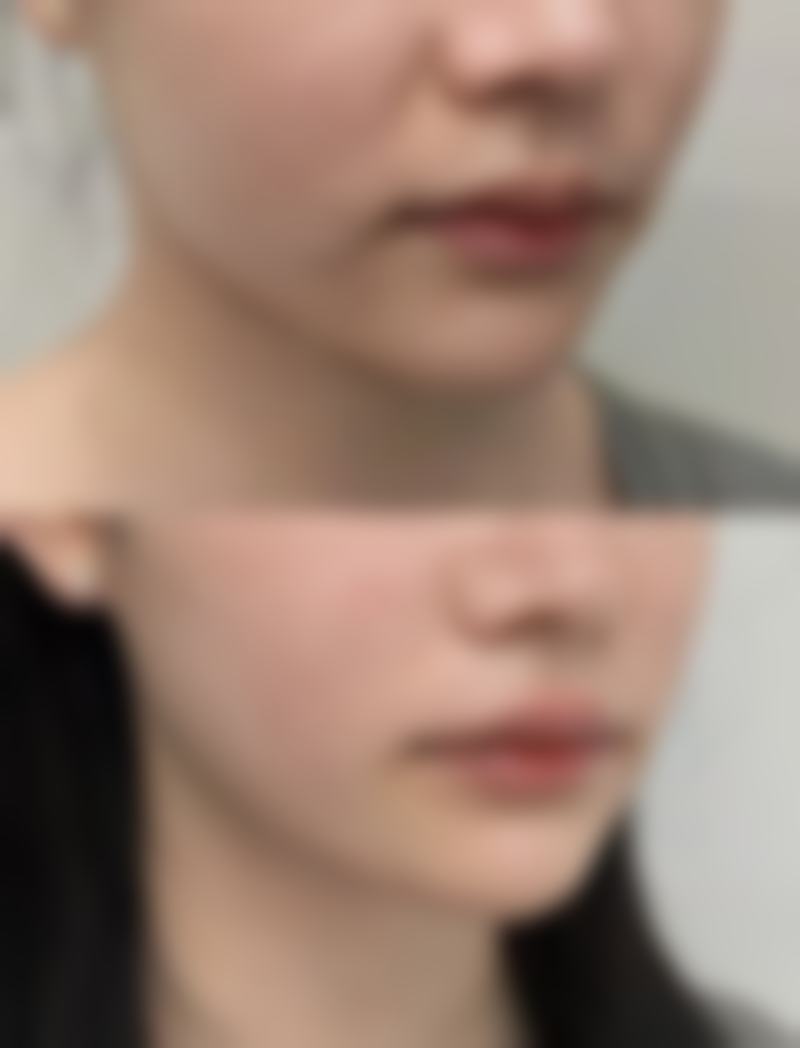 三、双眼皮拆线的操作步骤