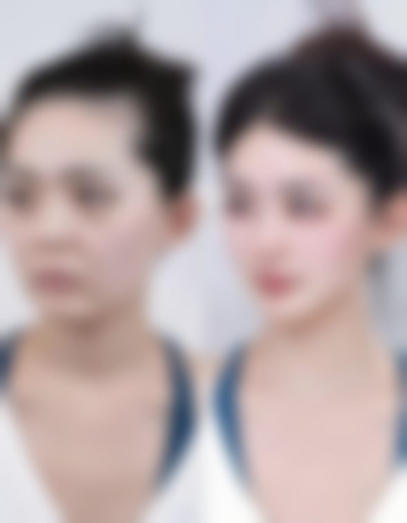 一、去眼袋用什么方法正确之了解眼袋成因