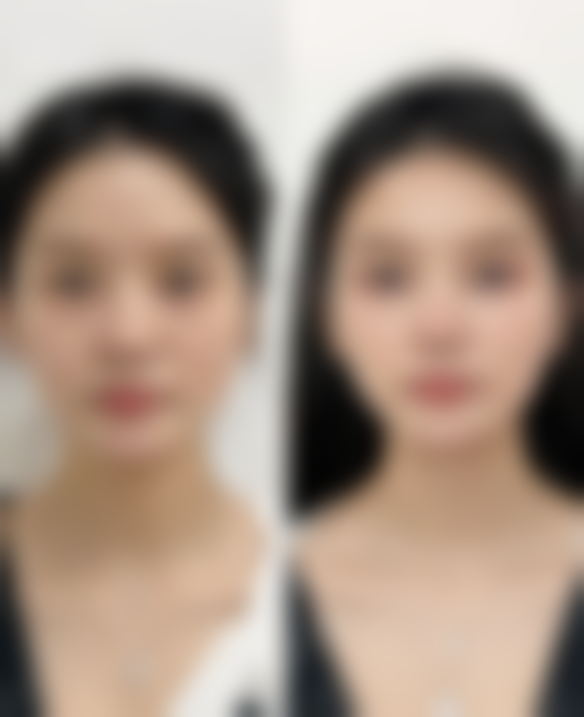 六、双眼皮拆线后的修复情况