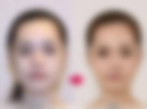 割了双眼皮比以前难看怎么办？教你多招应对恢复眼部自然美观！ 