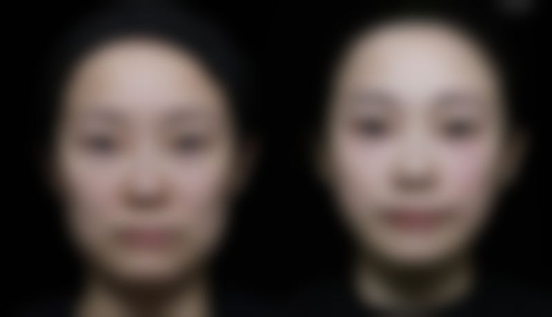 四、割完双眼皮除了吃笋的其他修复注意事项