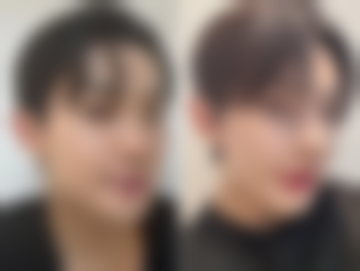 祛疤膏能治疗凹陷疤痕吗？了解使用方法与局限，科学应对凹陷疤痕修复