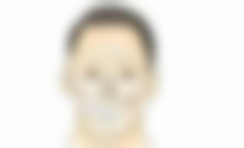 三、割双眼皮术前设计要点