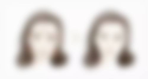 割双眼皮6天可以拆线吗？看割双眼皮20天恢复图了解拆线与恢复那些事儿