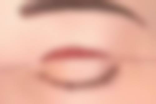 四、深蓝射频除皱术后护理要点