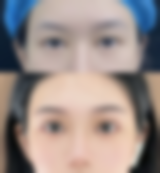 三、轻医美改善女人眼袋下垂松弛的方案