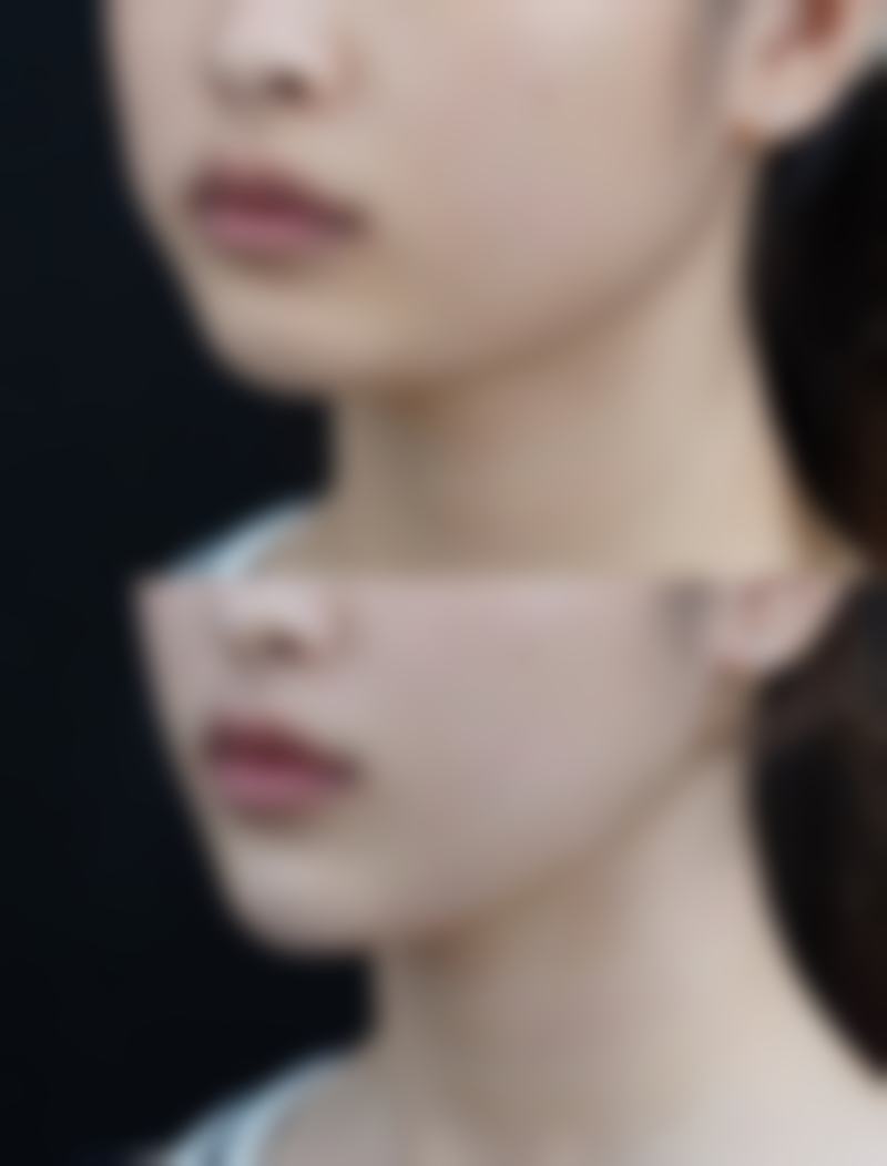 一、女人眼袋下垂松弛的成因分析