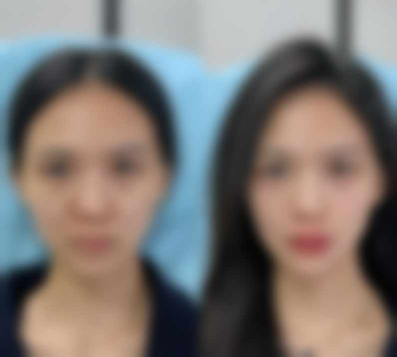 二、全身抽脂的塑形成效