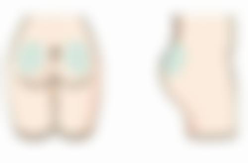 五、隆胸美学设计建议