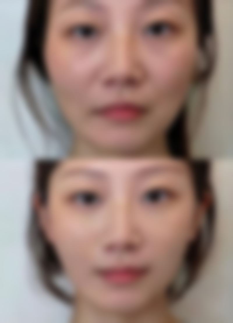 隆胸都是用硅胶吗?总结与建议