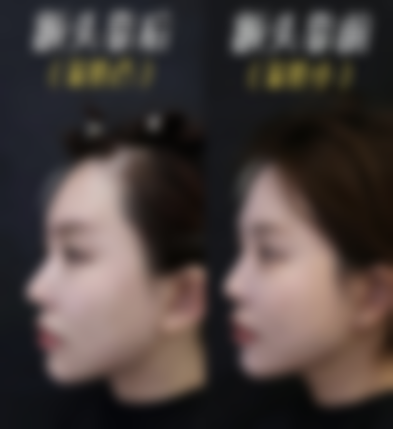 二、自我评估眼袋类型