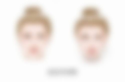 三、内切眼袋术后各阶段修复情况及注意事项