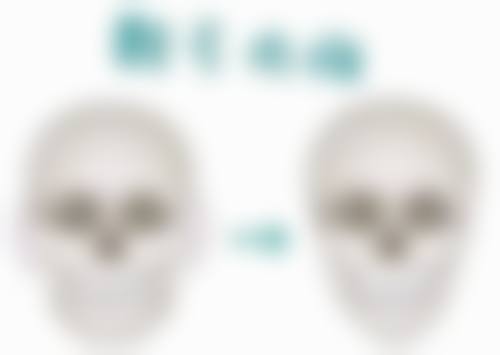 二、内切眼袋手术修复时间全知道