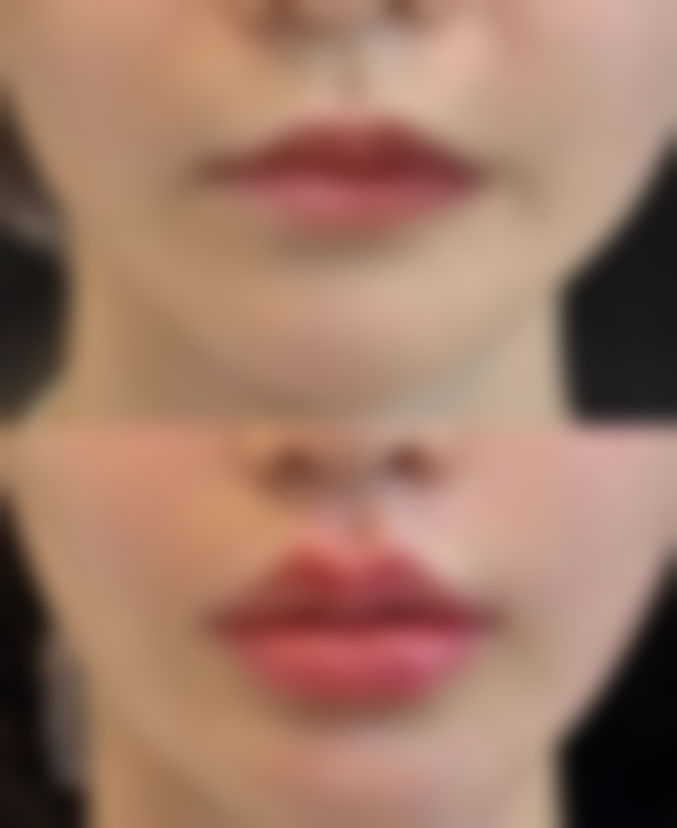 一、了解黑眼圈与眼袋的类型