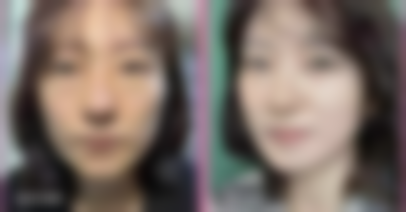 六、双耳软骨隆鼻成效减退后的修复