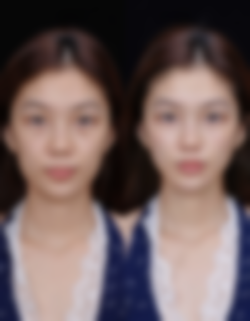 五、国产衡力瘦脸针的护理与注意事项