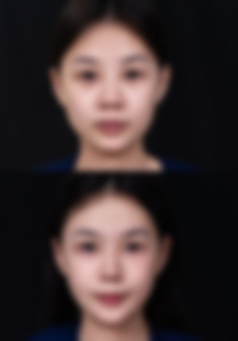 三、去眼袋的方法