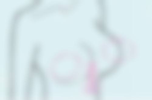 三、不同深度凹陷疤痕的修复时间及护理