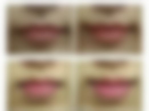 一、凹陷疤痕形成的原因