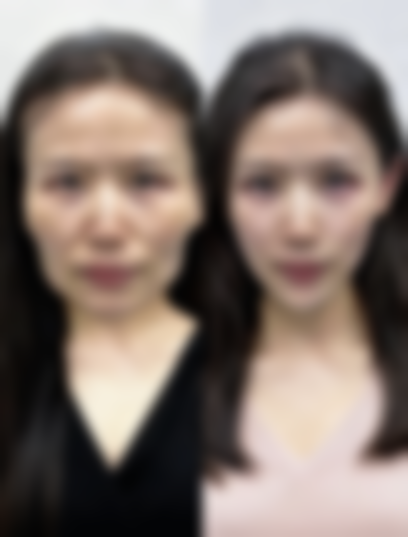 二、治疗凹陷疤痕的轻医美手段