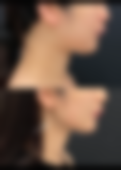 六、凹陷疤痕治疗的注意要点