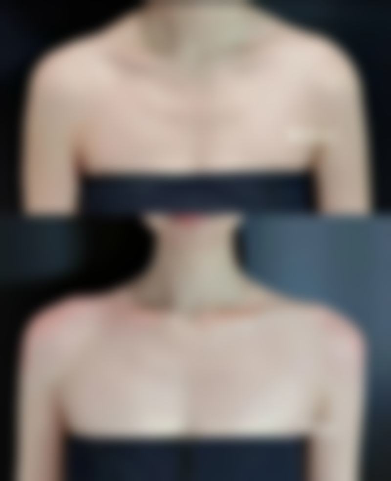 一、凹陷疤痕修复时间的大致范围