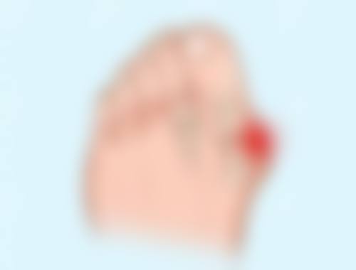 二、怎么样消除眼袋和黑眼圈之主流解决方案