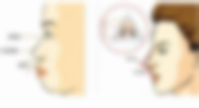 广州高尚医学美容中心余文林医生自体脂肪隆胸49800元，塑造自然饱满美胸 