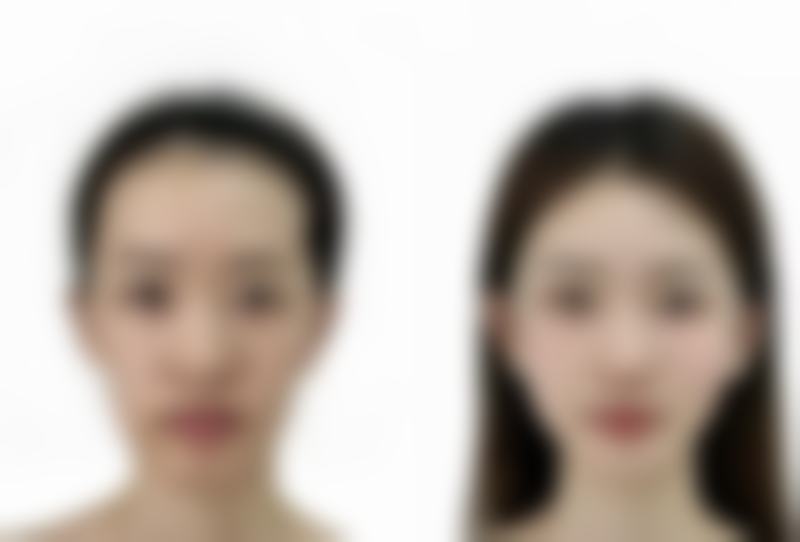 内吸眼袋能维持多久？受体质、护理等因素影响，一般可维持5 - 10年！ 