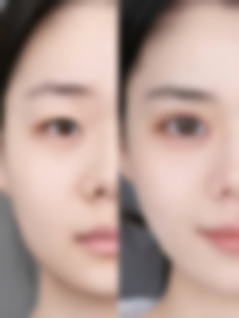 三、如何延长内吸眼袋成效