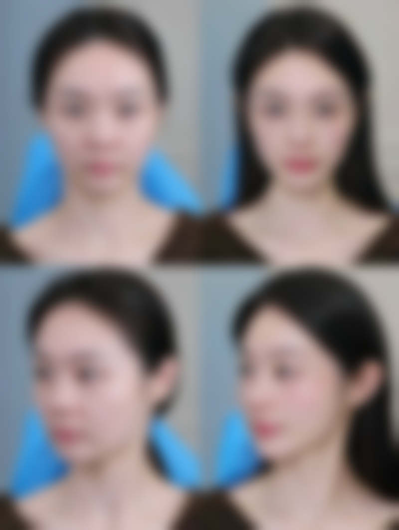 五、隆胸手术能坚持多久：长久保持理想成效秘诀