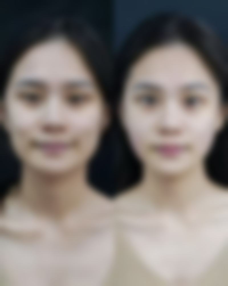 三、做假体隆胸的美学与安心小贴士