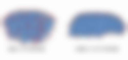 四、哪韩式双眼皮手术好之适合人群与禁忌