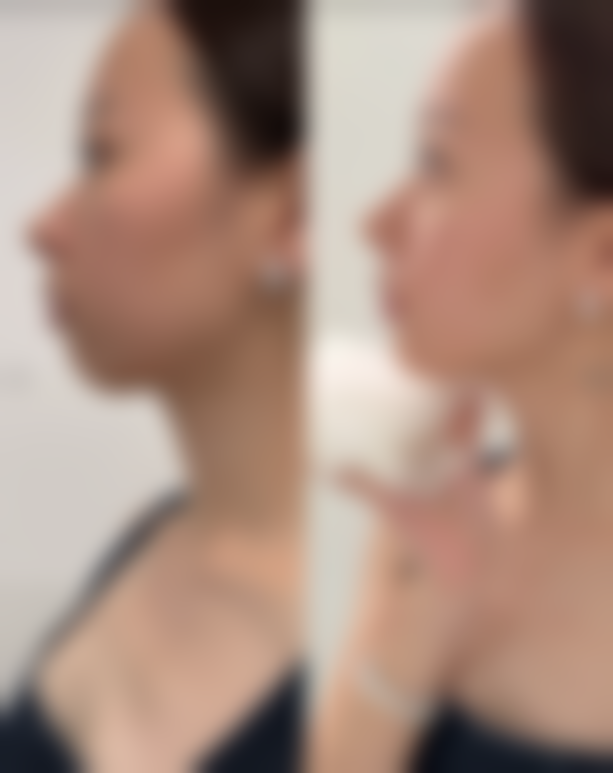 五、严肤修复疤痕与其他修复方法的对比