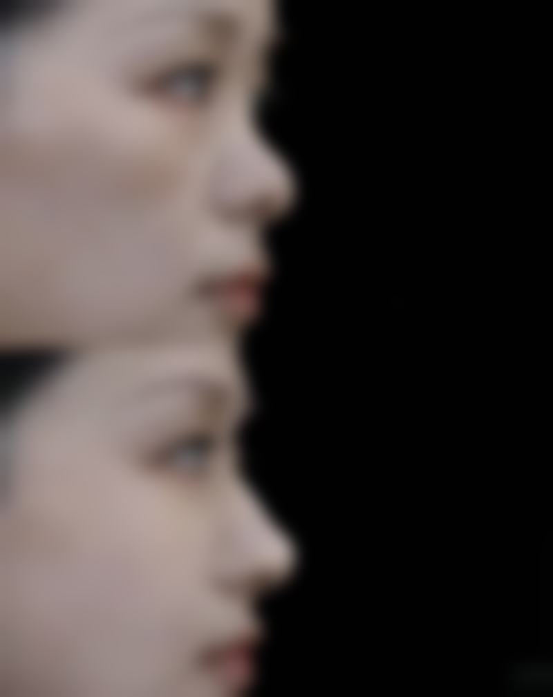 三、哪韩式双眼皮手术好之术后成效与风险提示