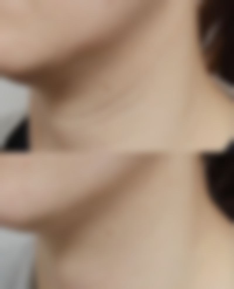 七、哪韩式双眼皮手术好之术后护理事项