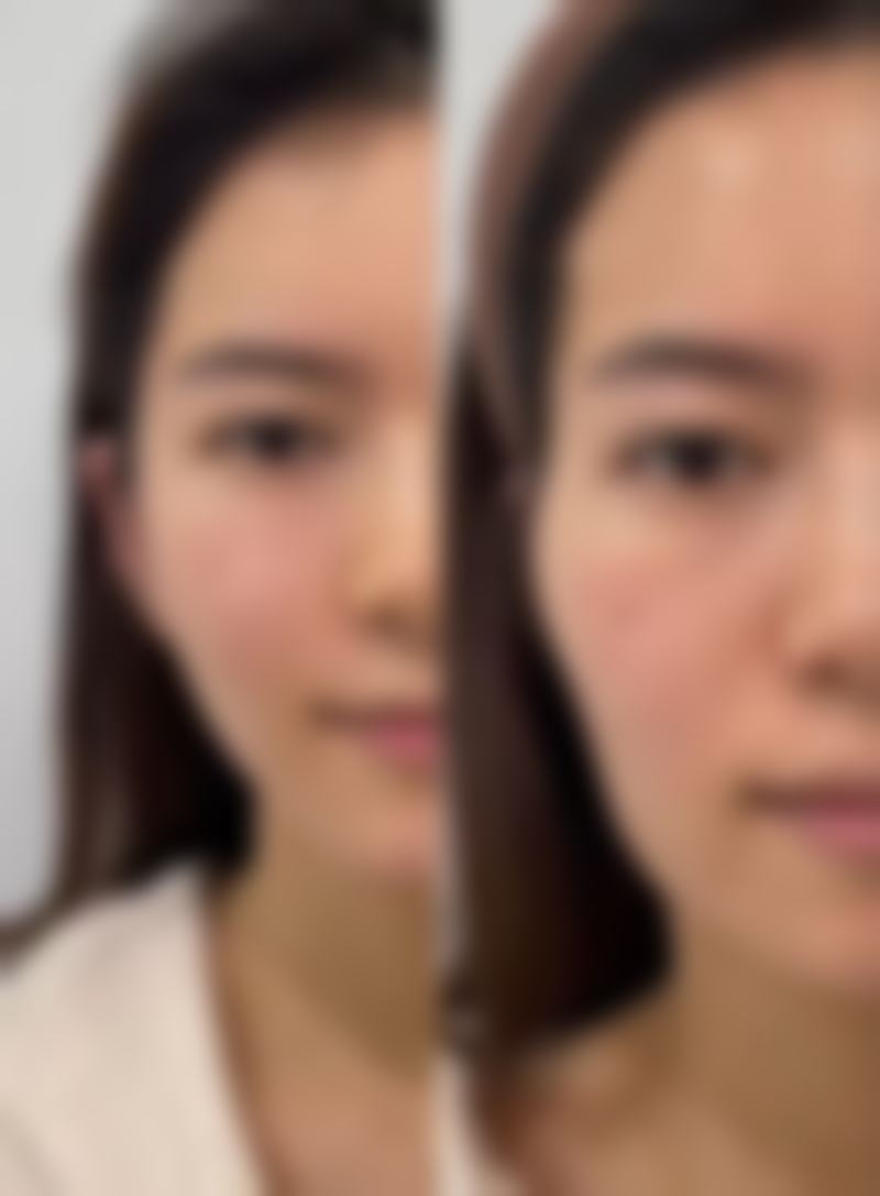 一、了解眼袋类型与成因