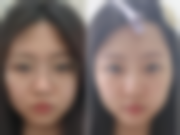 三、不同术式的修复时间和成效维持时间