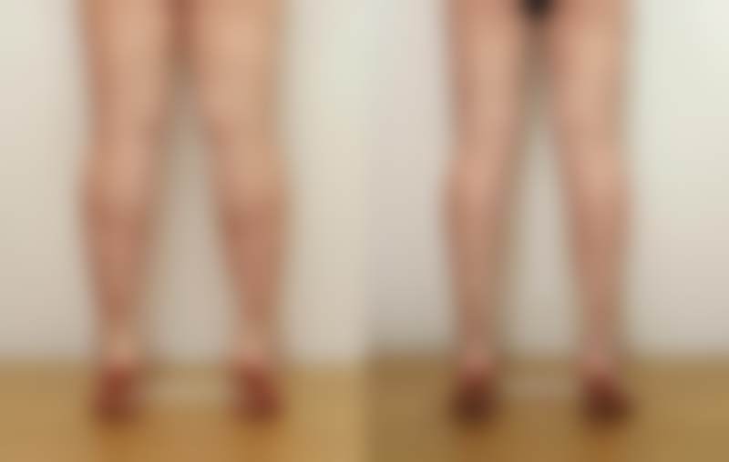 2026韩国sage医院李敬秀收费标准揭秘，含纤腓针及大腿塑形等项目价格 