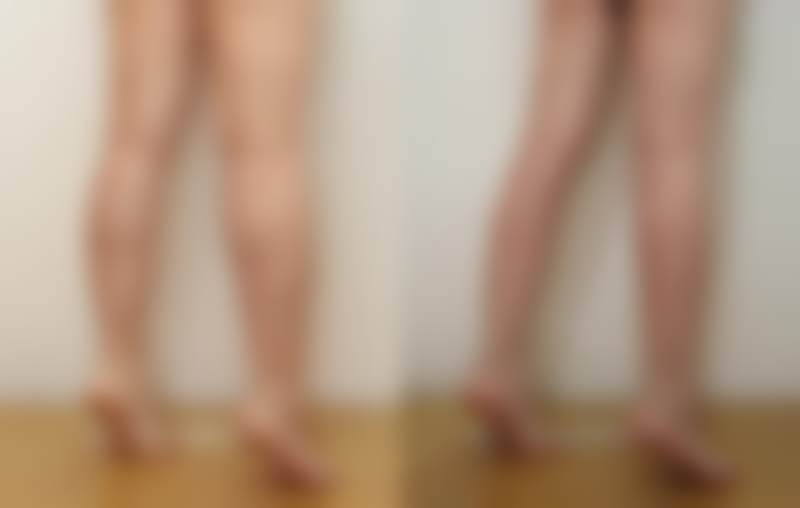 四、韩国sage医院的特色项目——纤腓针