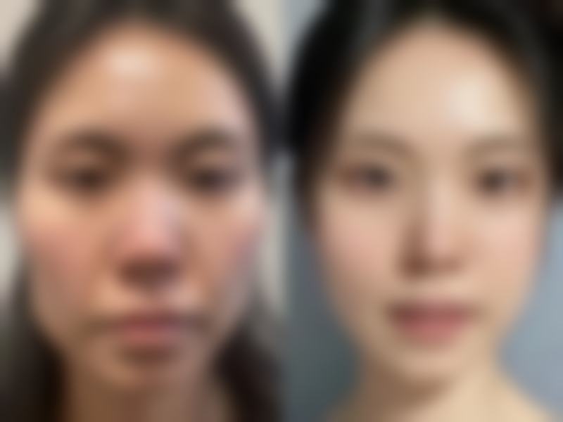 做双眼皮手术前要准备什么？身体、心理、物品全方面准备指南请查收！ 